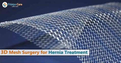 dr richard miller hernia mesh removal|FAQs about Mesh in Hernia Repairs — What Patients Need.